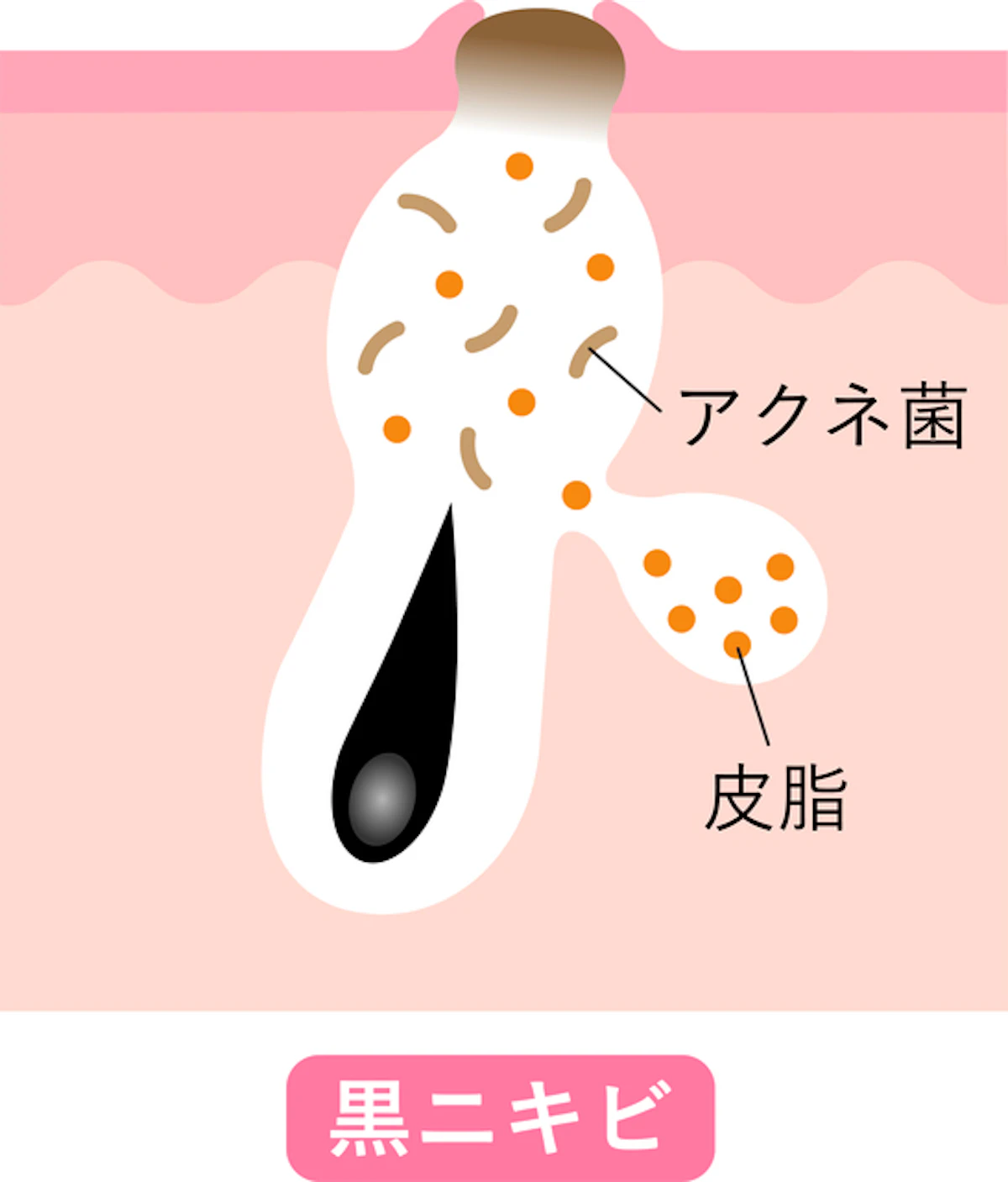 黒ニキビ