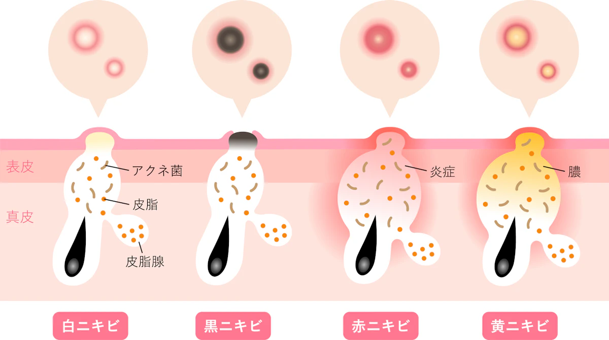 ニキビ種類