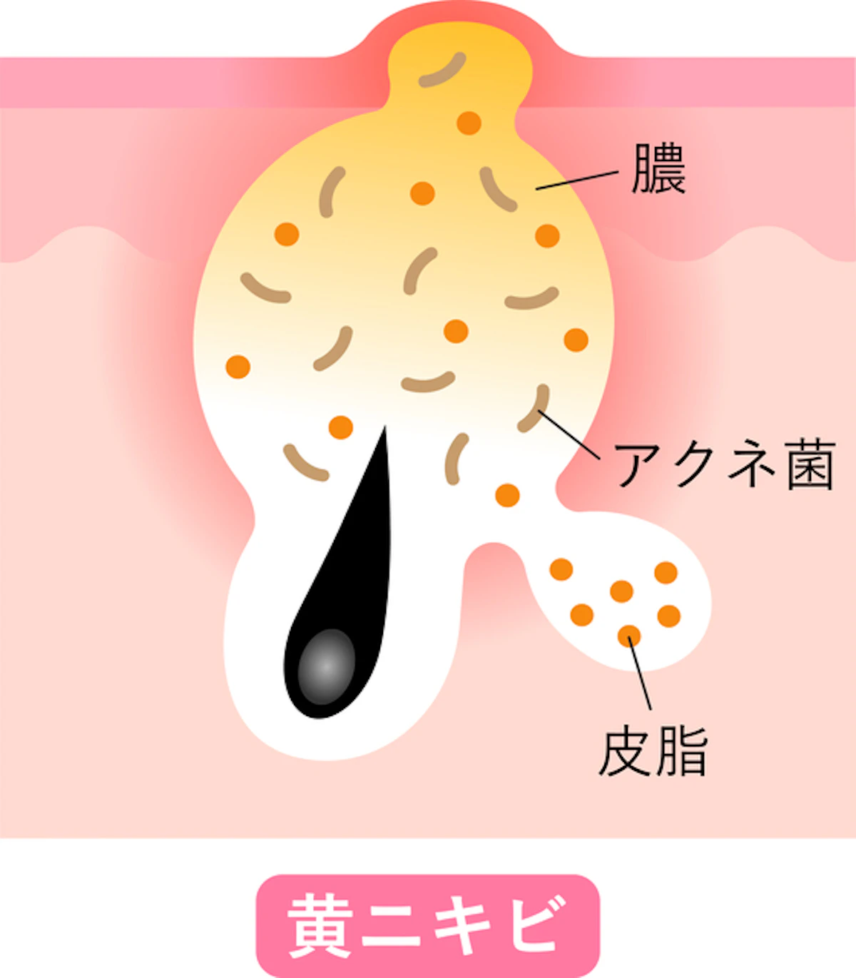 黄ニキビ