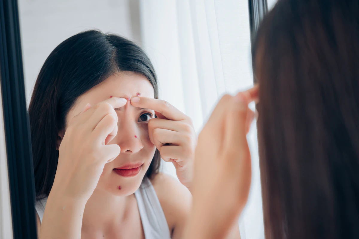 ニキビはつぶすとどうなる?跡を残さない正しいケアと予防法