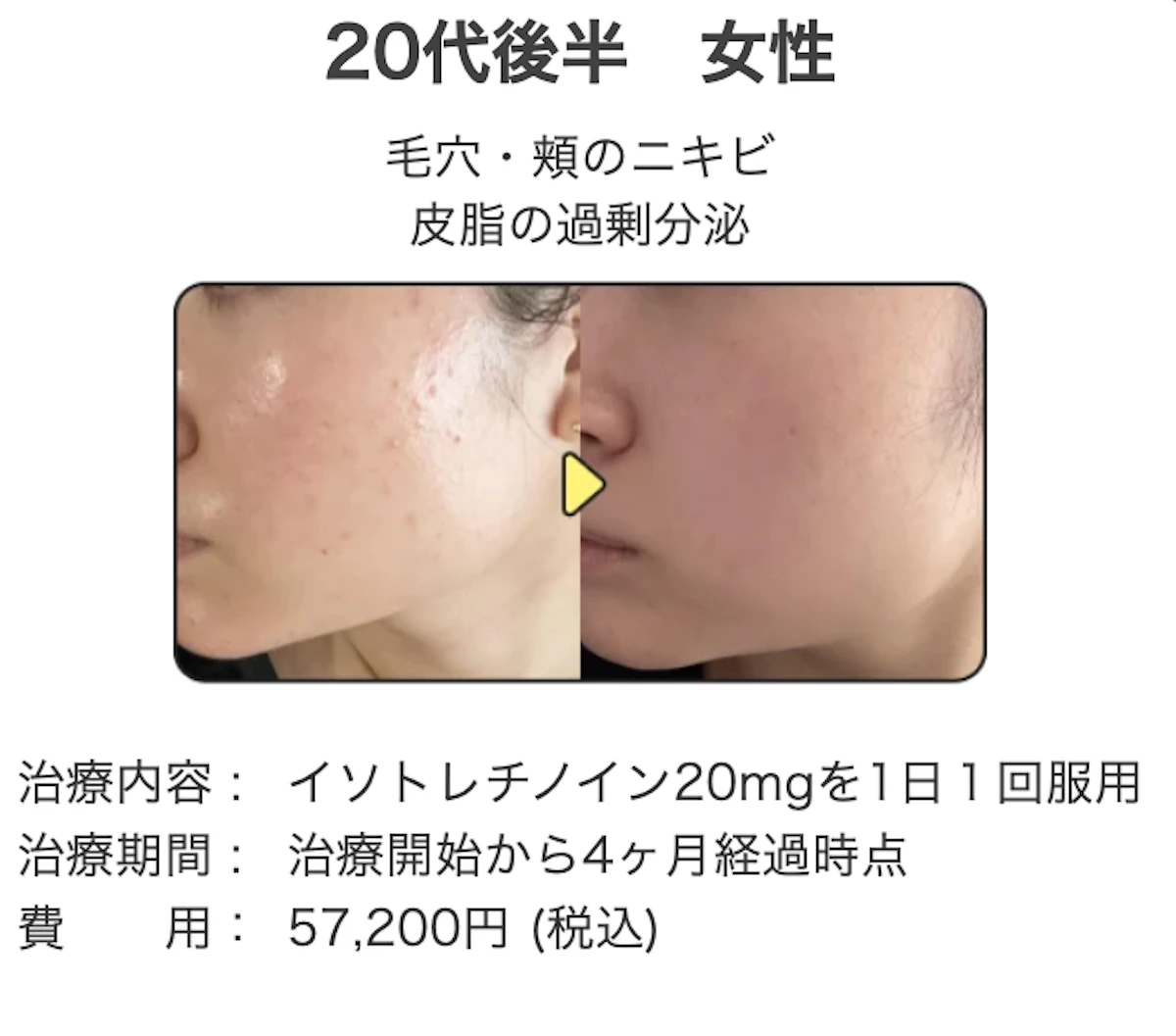 イソトレチノイン20㎎治療開始経過症状