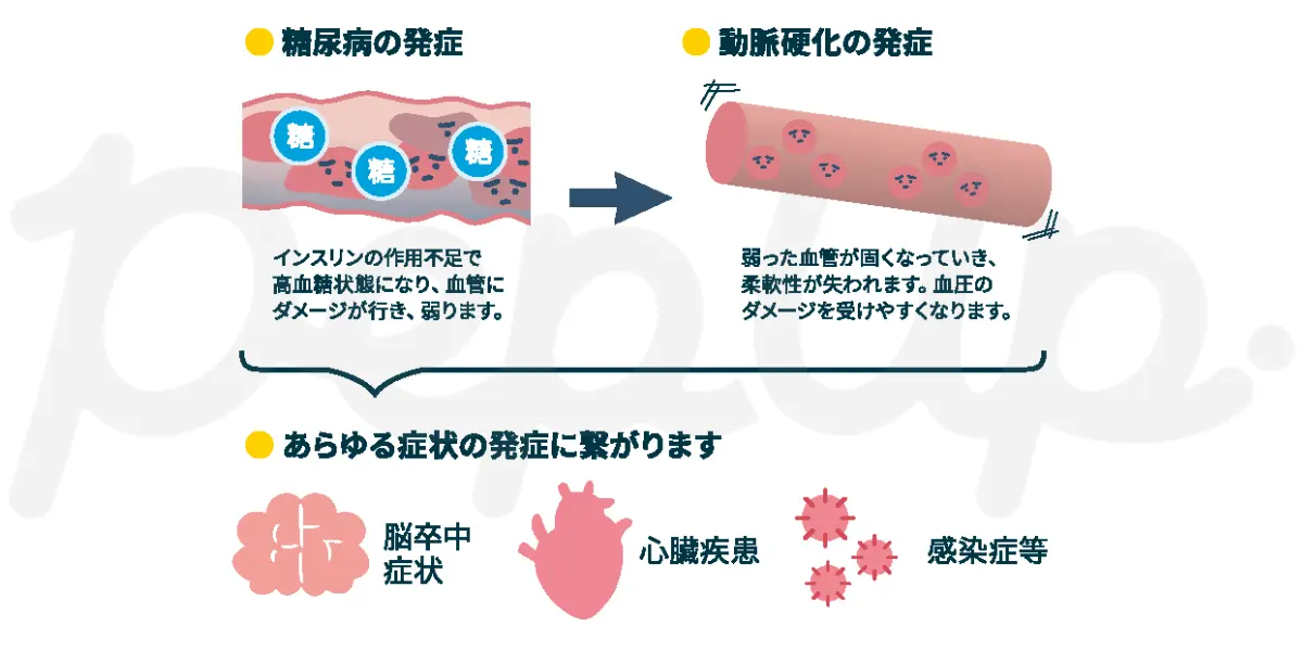 高血糖による糖尿病と動脈硬化から脳卒中や心臓疾患などに至る流れの図