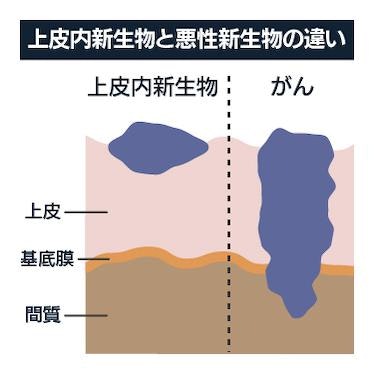 上皮内新生物とがん（悪性新生物）の違い