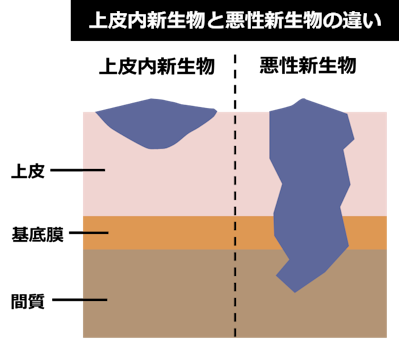 上皮内新生物と悪性新生物の違い