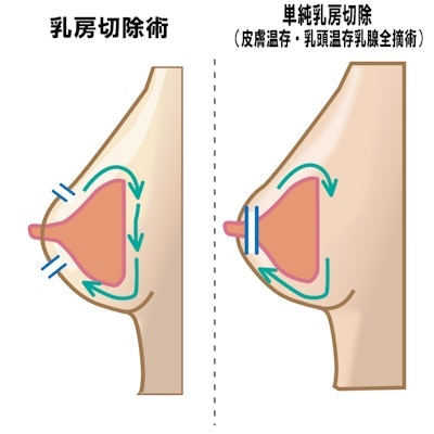 乳がんの手術方法