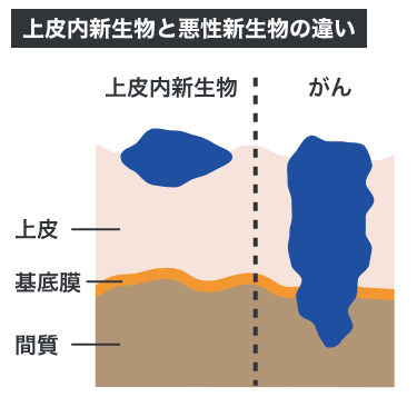 上皮内新生物と悪性新生物の違い