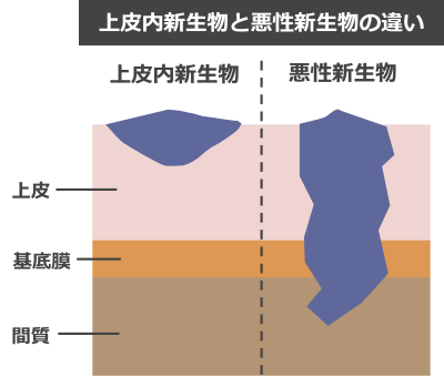 上皮内新生物と悪性新生物の違い