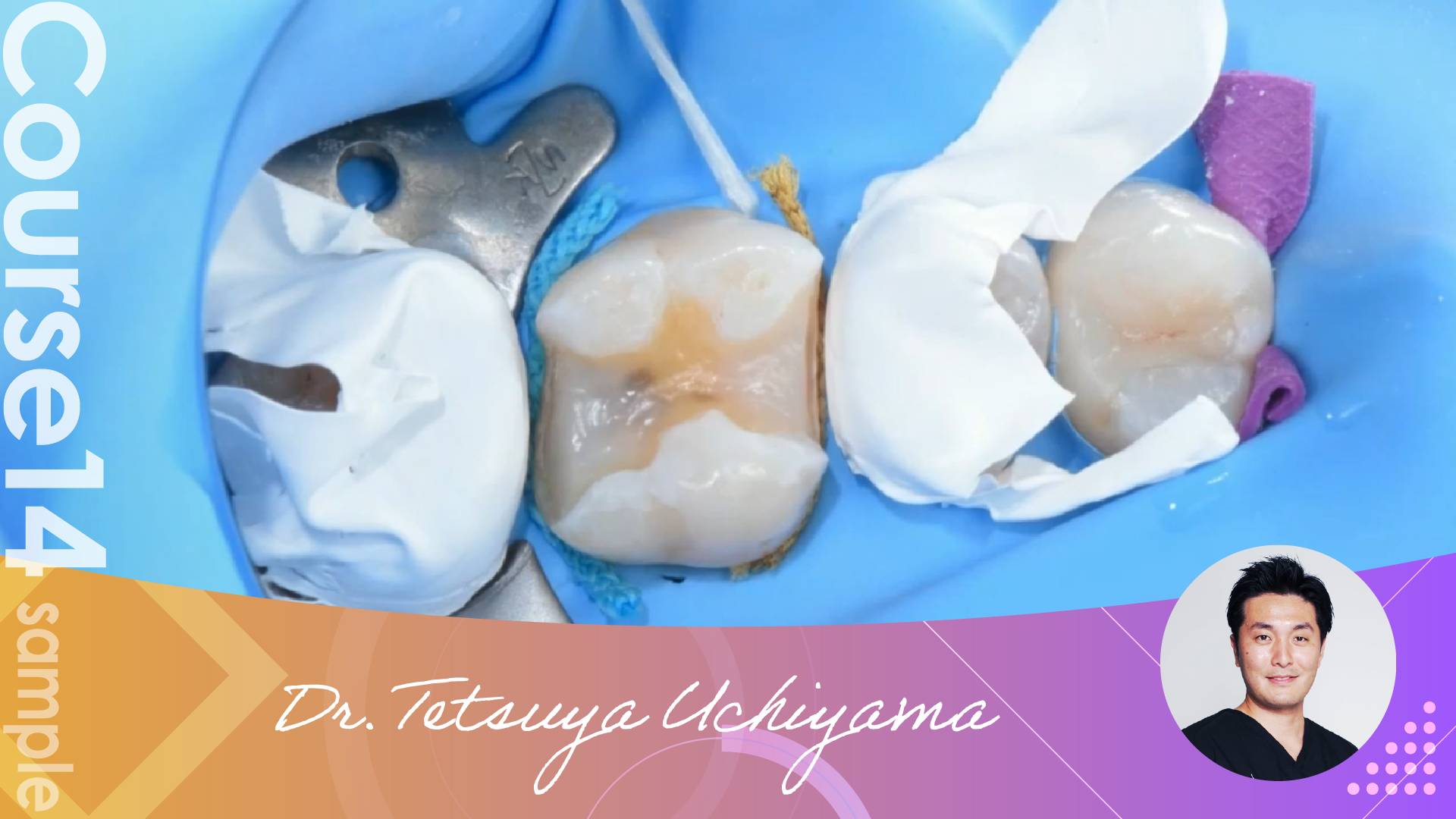 【sample】Inlay | Doctorbook global academy