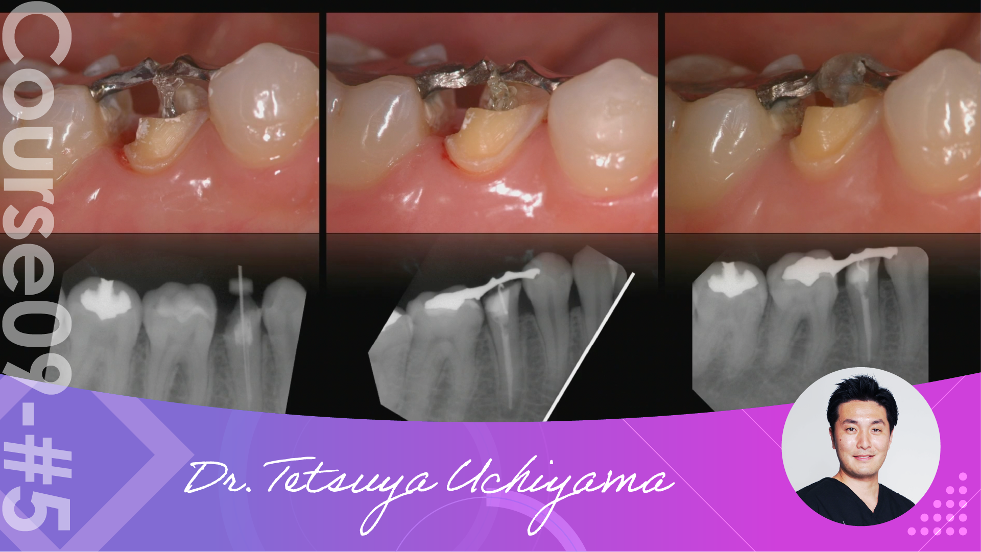 5 Tooth Extrusion Doctorbook global academy