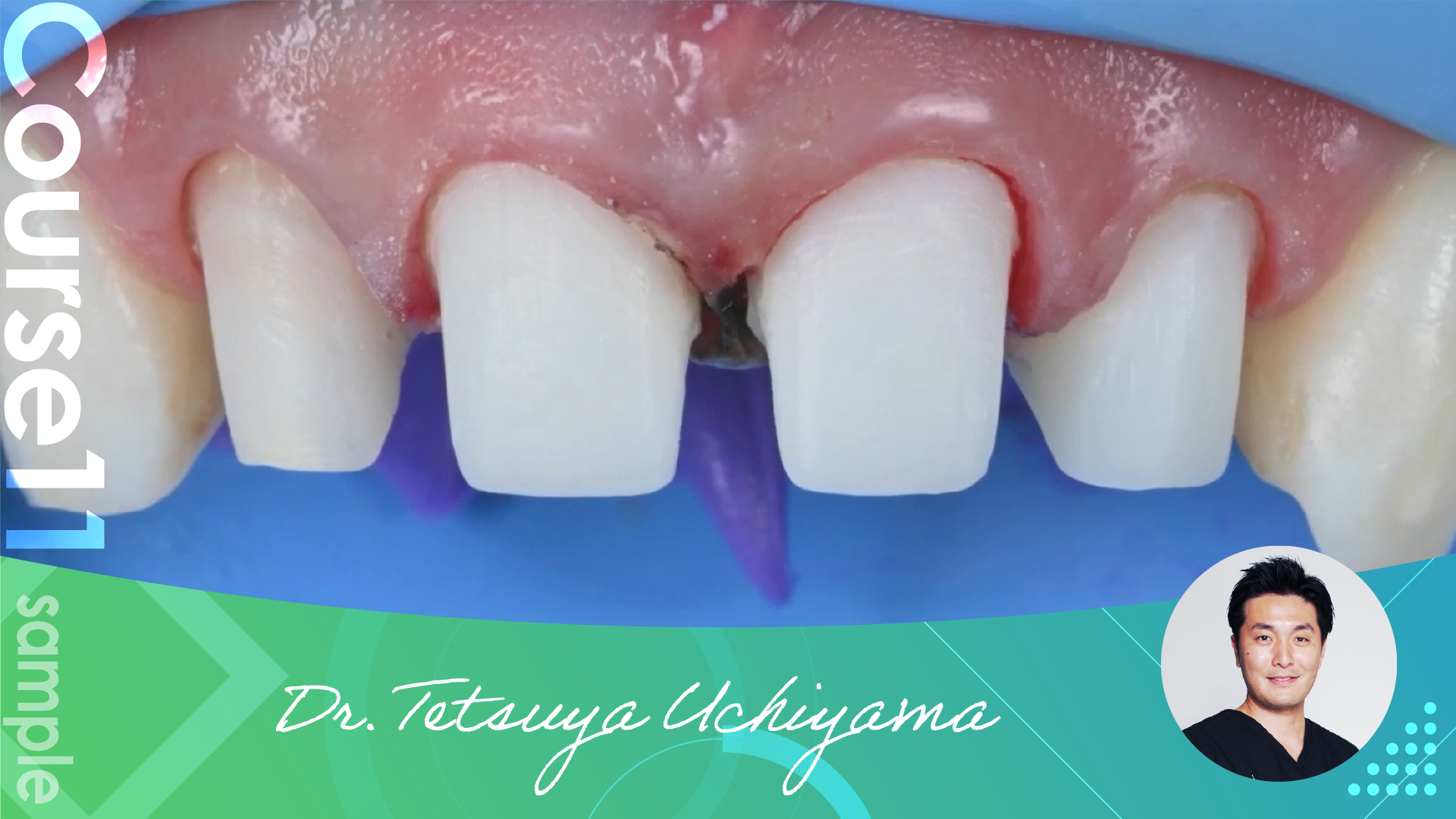 Abutment Procedure 1 Doctorbook global academy