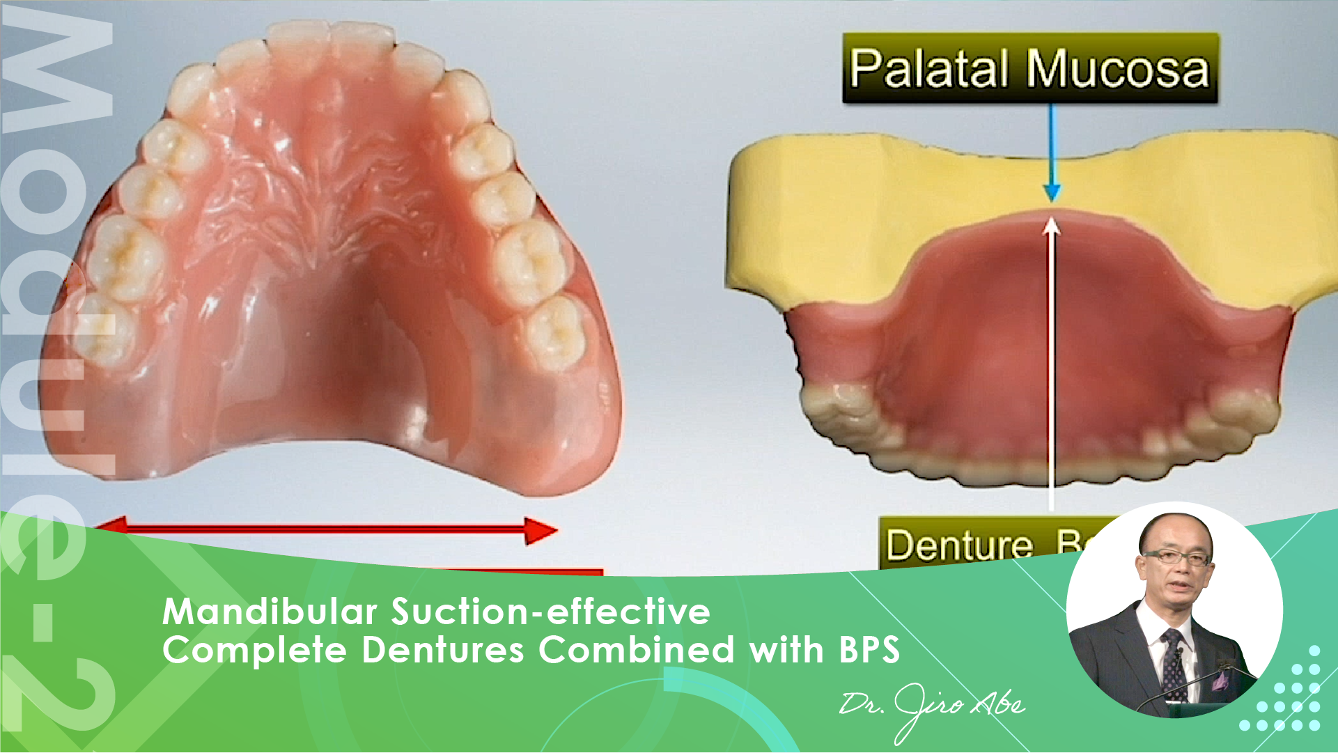Mandibular Suction-effective Denture 