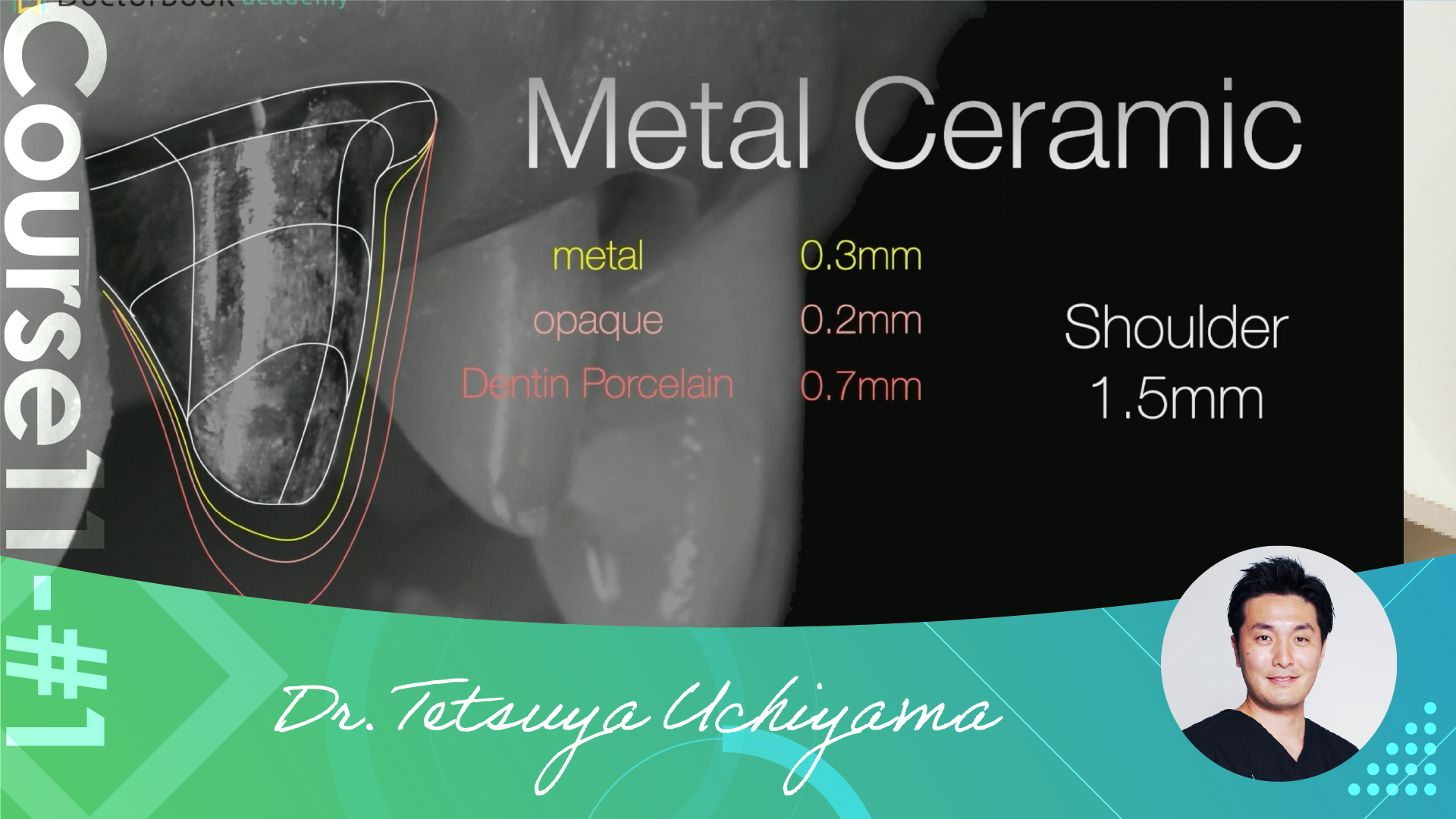 1 Comprehensive Abutment Procedure overview case presentation