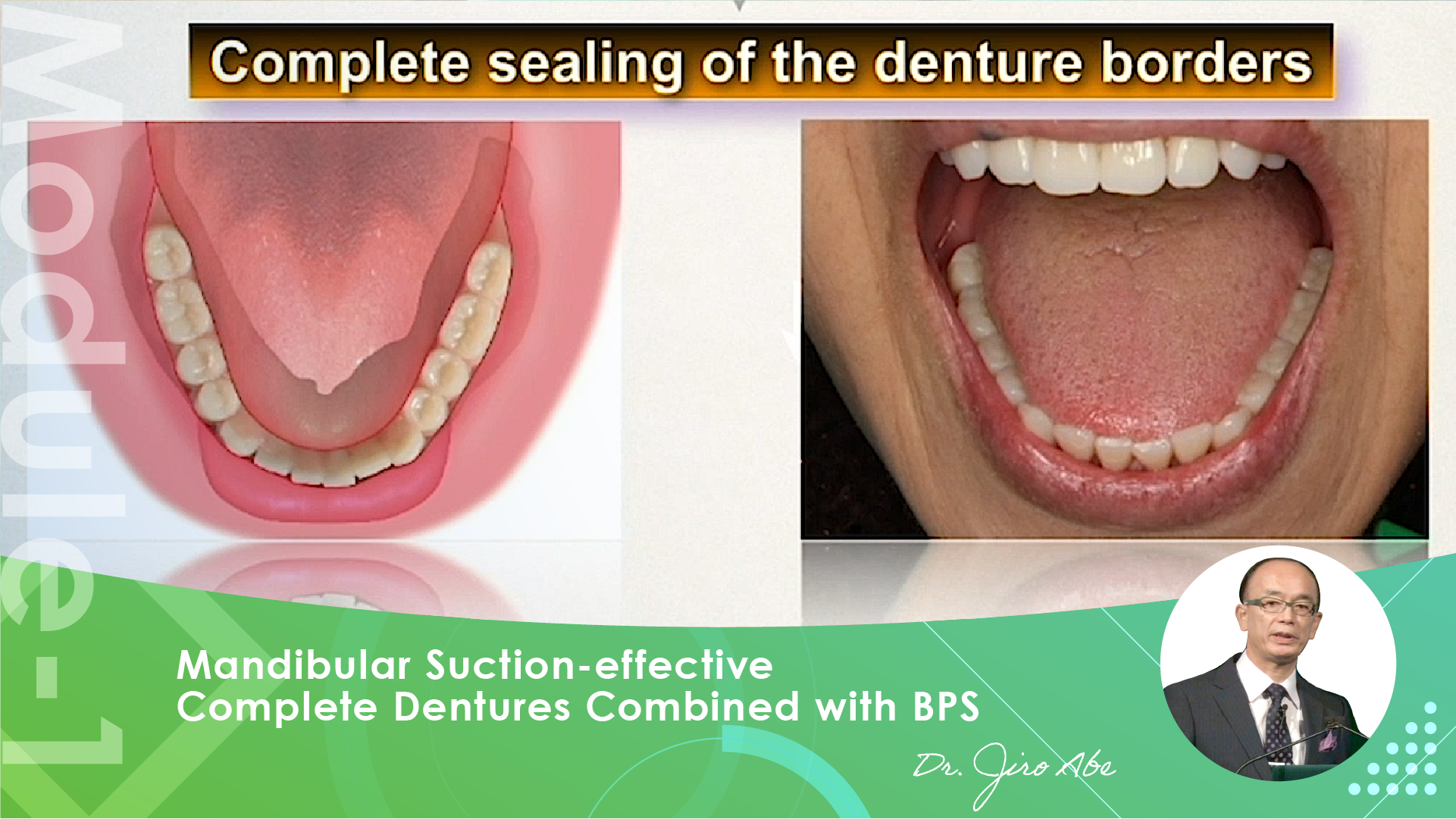 Mandibular Suction-effective Denture 
