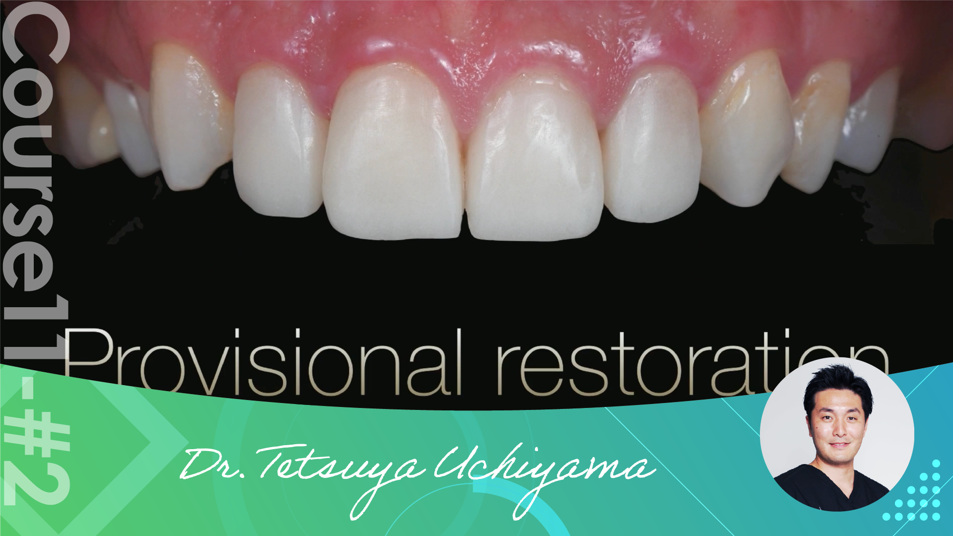 #2 Digital Dentistry enabling thinnest provisional restorations ...
