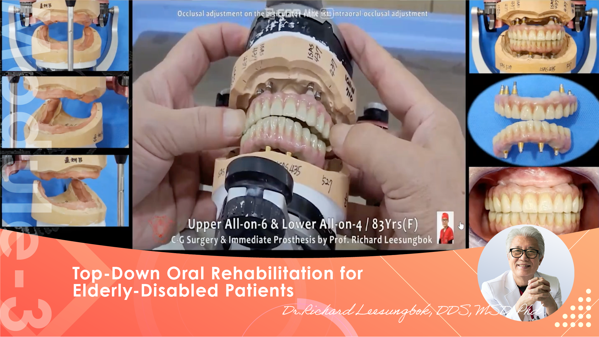 Elderly edentulous transition from Complete Dentures to Fixed hybrid ...