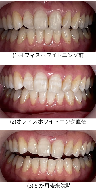 ホワイトニング　30回使用 ホワイトニングで歯の寿命は縮まる？ホワイトニングの安全性と注意点