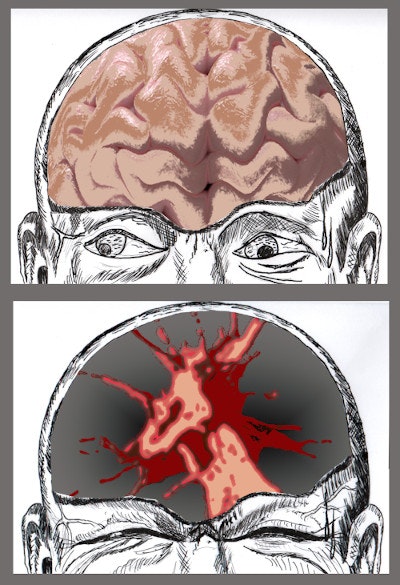 Benzodiazepine Withdrawal Symptoms - Feeling that brain is about to burst